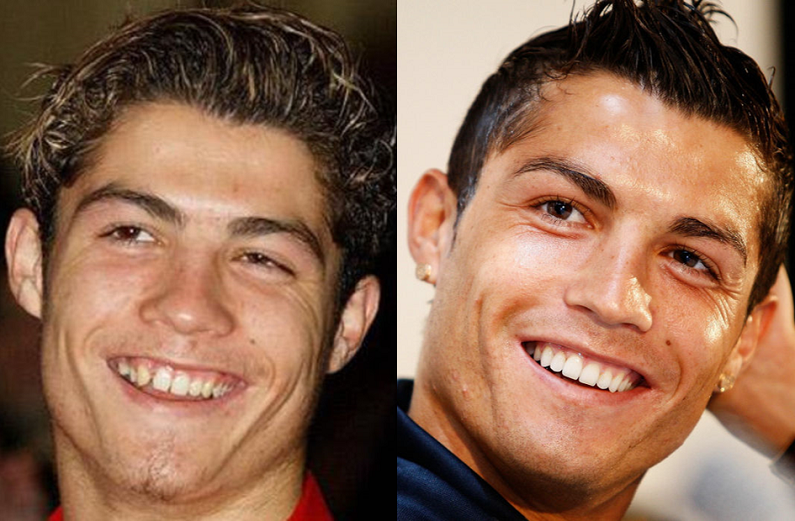 cristiano-facette-dentaire.png
